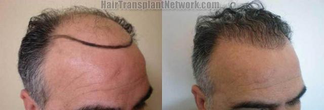 Hair transplantation surgery before and after images