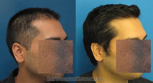 Hair restoration procedure before and after results