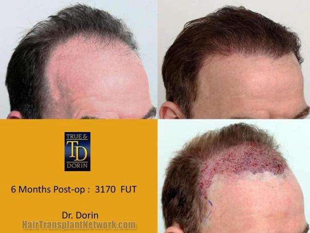 Hair transplantation surgery before and after images