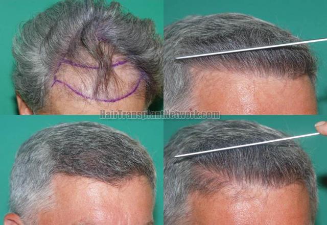 Hair restoration procedure before and after results