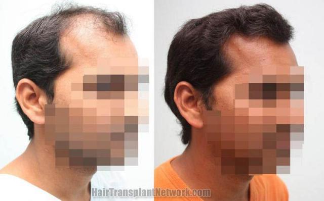 Hair transplantation surgery before and after images