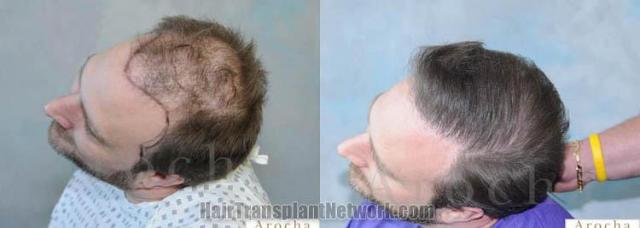 Hair transplantation surgery before and after photos