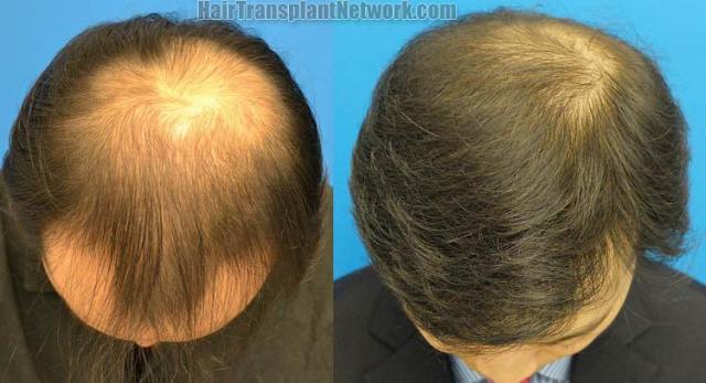 Hair transplantation surgery before and after photos