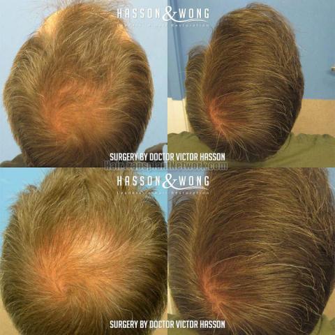 Hair replacement surgery before and after images