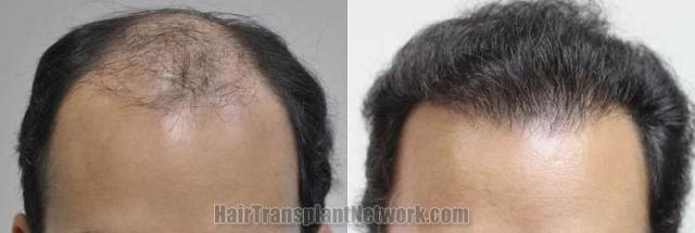 Hair restoration procedure before and after results