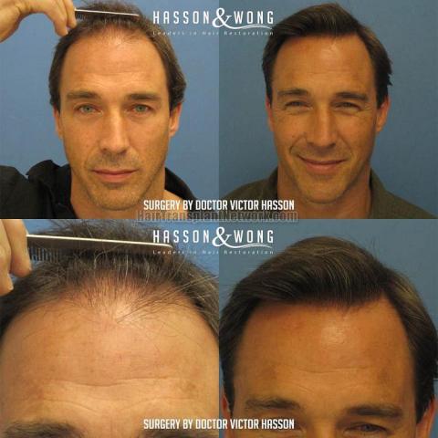 Hair transplant surgery before and after pictures