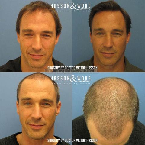 Front view - Before and after hair restoration procedure