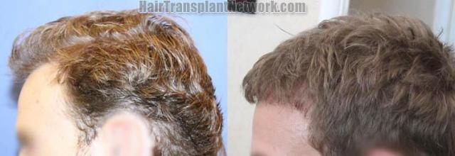 Hair transplantation surgery before and after images