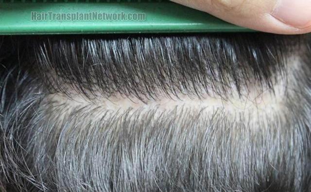 Hair restoration procedure before and after pictures