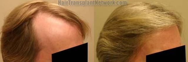 Right view before and after hair restoration results