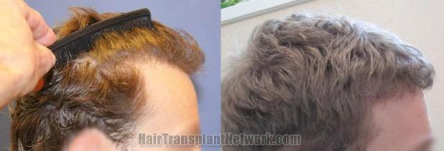 Hair transplantation surgery before and after photos