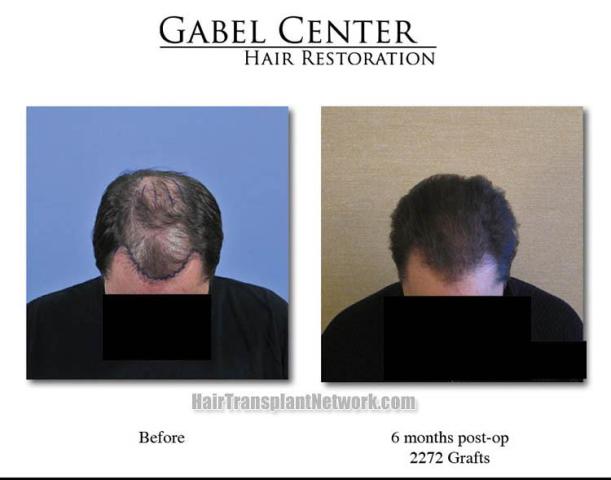 Hair transplantation surgery before and after photos