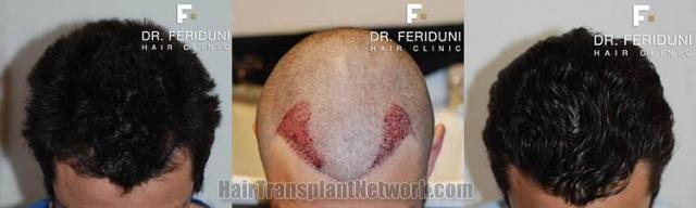 Top view before and after hair restoration results