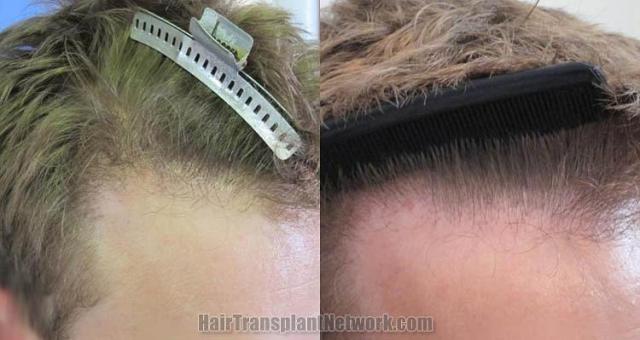 Hair transplantation surgery before and after pictures