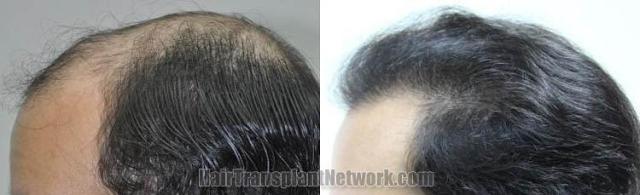 Hair transplantation surgery before and after pictures