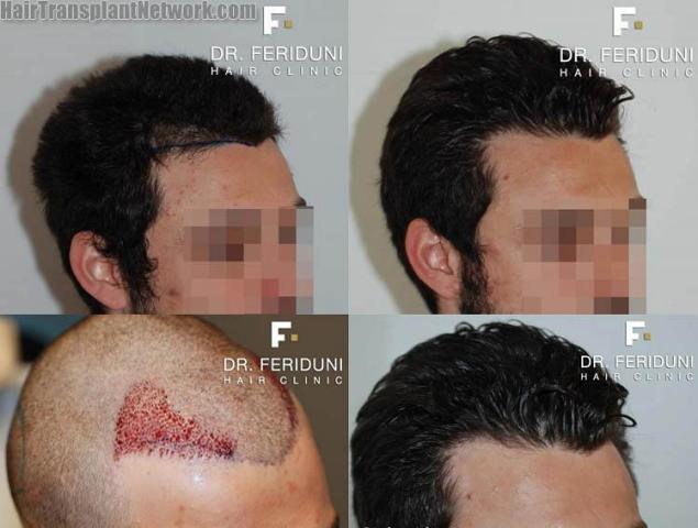 Hair transplantation surgery before and after photos