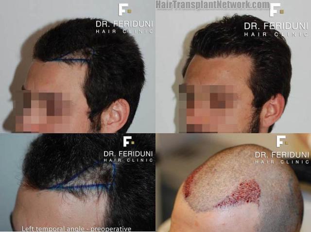 Hair transplantation surgery before and after pictures