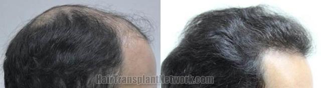 Hair transplantation surgery before and after images