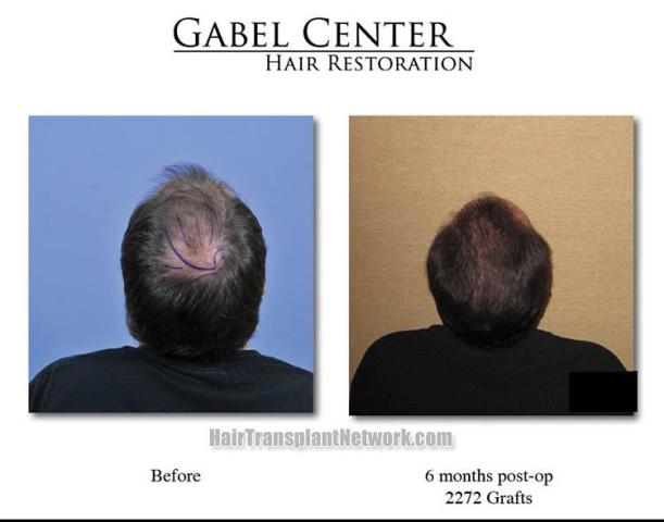 Surgical hair transplantation result photographs