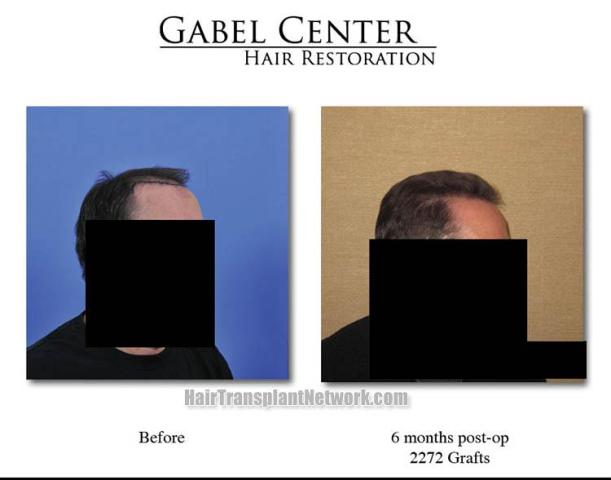 Hair transplantation surgery before and after images