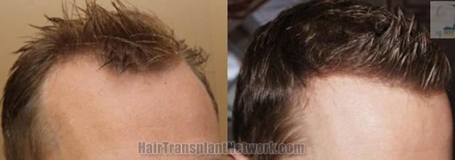 Hair transplantation surgery before and after images