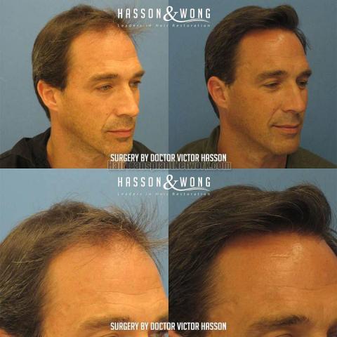 Hair transplant surgery before and after images