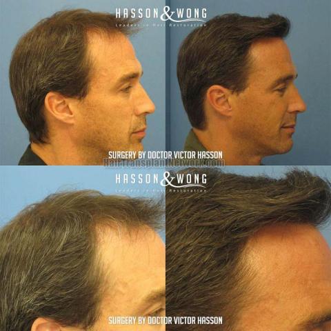 Hair restoration procedure before and after result images