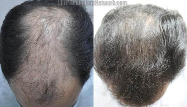 Hair transplantation surgery before and after photos