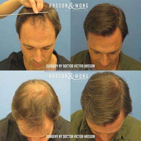 Before and after hair transplant procedure images