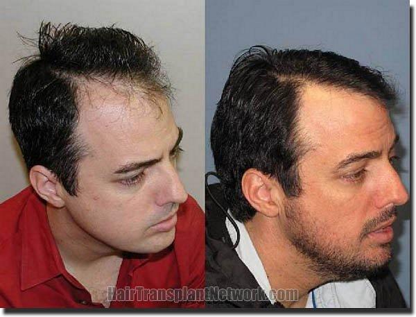 Hair restoration procedure results