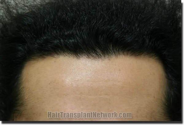 Hair restoration procedure results