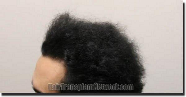 Hair restoration procedure results