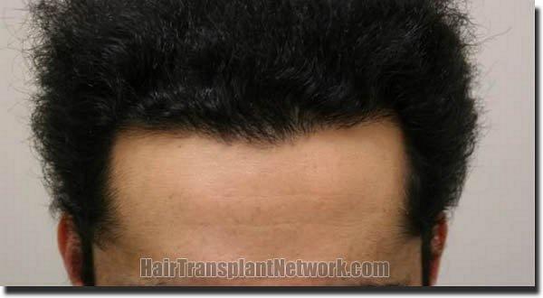 Hair restoration procedure results