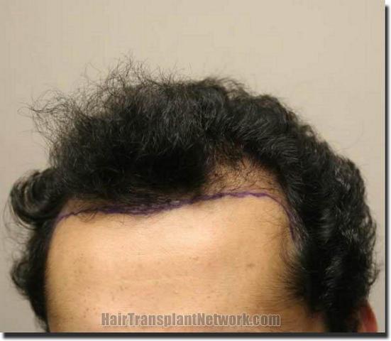 Hair restoration procedure results