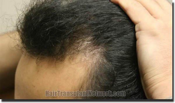 Hair restoration procedure results