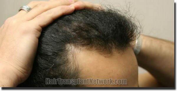 Hair restoration procedure results