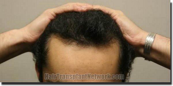 Hair restoration procedure results