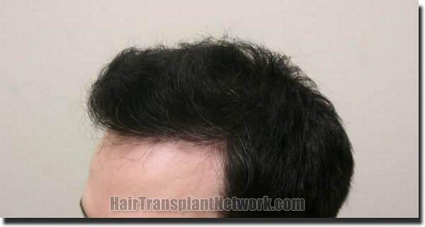 Hair restoration procedure results