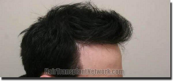 Hair restoration procedure results