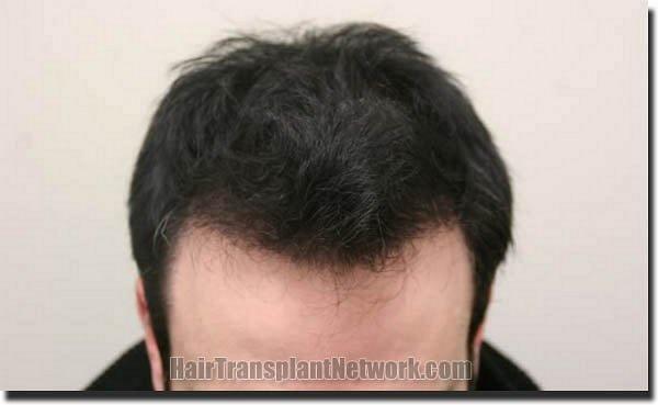 Hair restoration procedure results