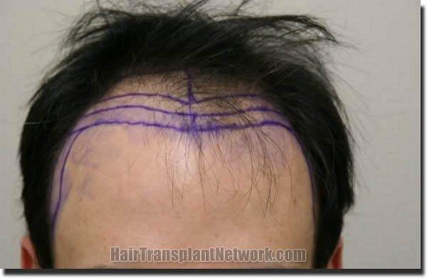 Hair restoration procedure results