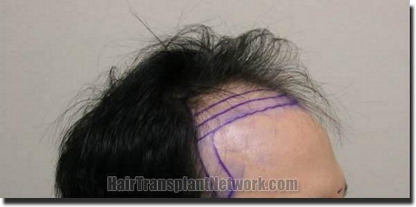 Hair restoration procedure results