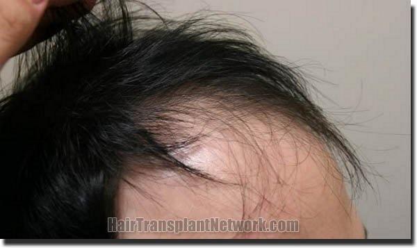 Hair restoration procedure results