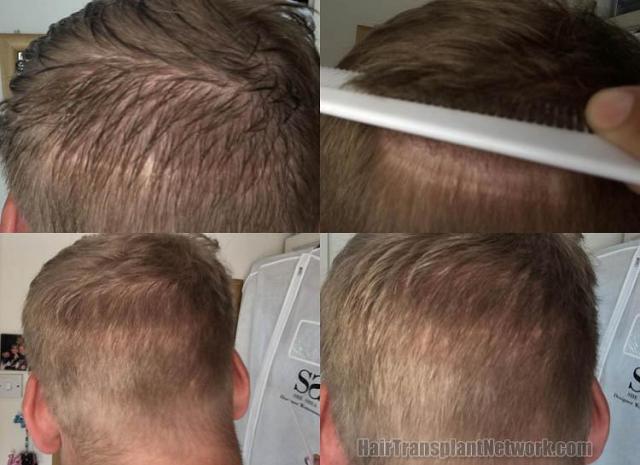 Surgical hair transplantation result photographs