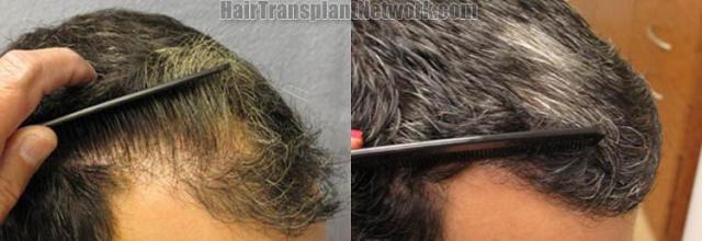 Hair transplantation surgery before and after pictures