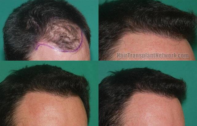 Hair restoration procedure before and after results