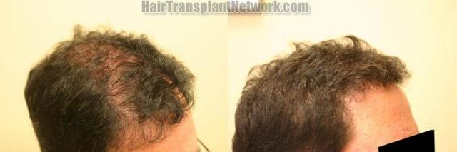 Hair transplantation surgery before and after images