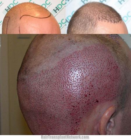 Hair transplantation surgery before and after photos