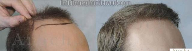 Hair transplantation surgery before and after photos