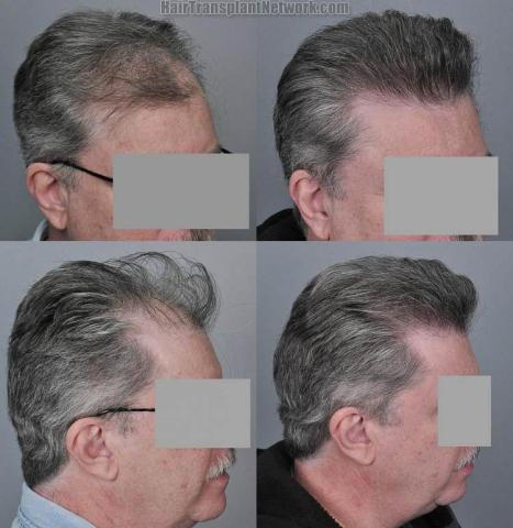 Hair transplantation surgery before and after images